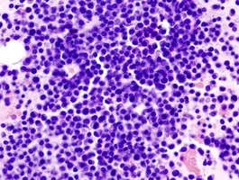 多発性骨髄腫の薬剤耐性化に対応する新しい手法