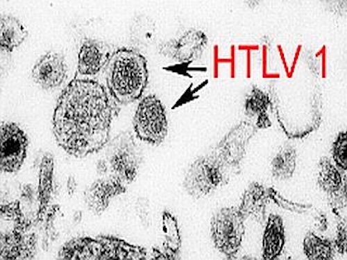 HTLV-1感染症に光明!既存のHIV治療薬が感染予防に有効であることを発見