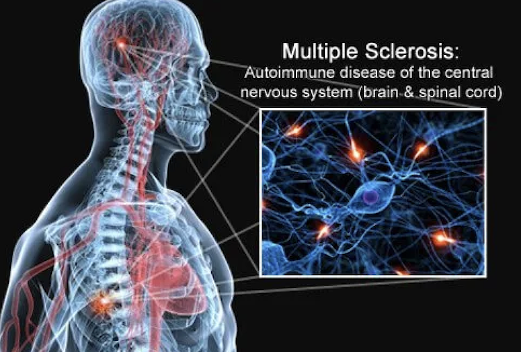 多発性硬化症の発症7年前に兆候あり?UCSFが血液中のタンパク質から特定