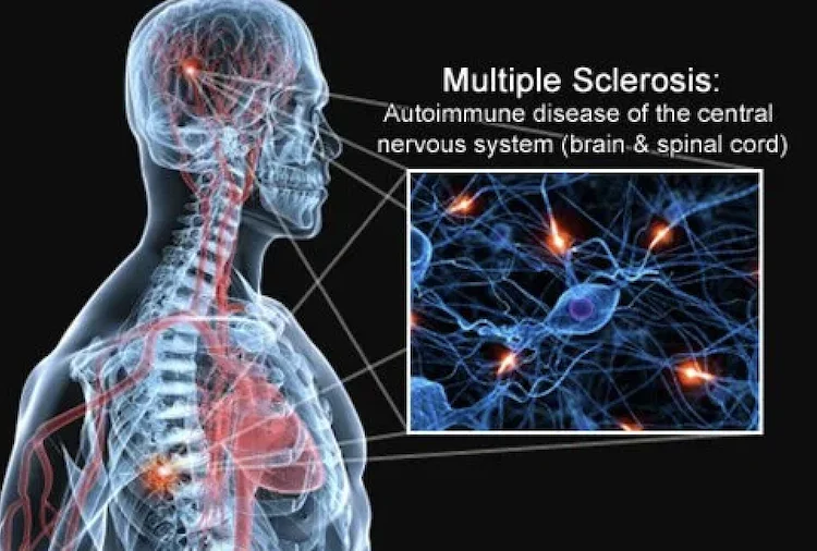 多発性硬化症の発症7年前に兆候あり？UCSFが血液中のタンパク質から特定